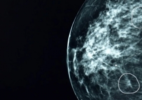 MIAAI，医疗界AI重大突破，提前3年发现11名乳腺癌用户
